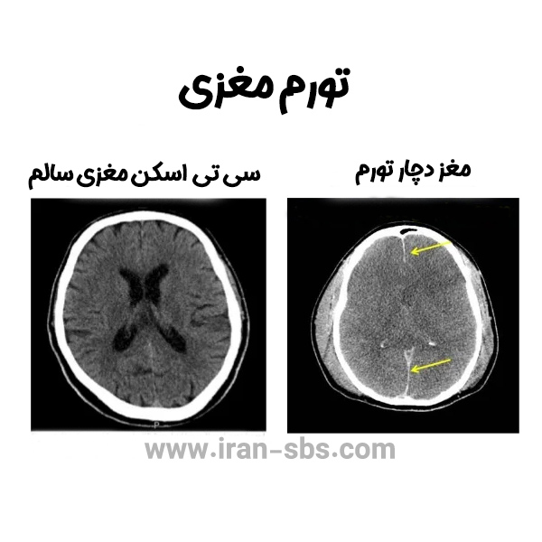 عکس سی تی اسکن تورم مغزی