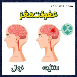 عفونت مغز + انجمن جراحان قاعده جمجمه