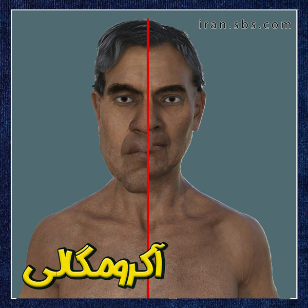 آکرومگالی + انجمن جراحات قاعده جمجمه