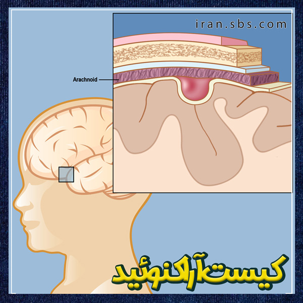 کیست آراکنوئید + جراحان قاعده جمجمه