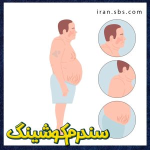 سندرم کوشینگ + جراحان قاعده جمجمه