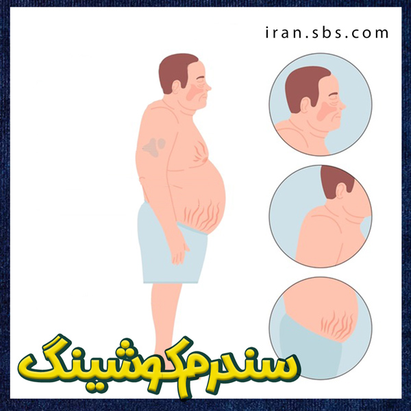 سندرم کوشینگ + جراحان قاعده جمجمه-iran-sbs.com