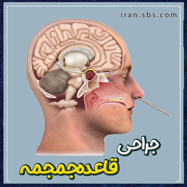 جراحی قاعده جمجمه | انجمن جراحان قاعده جمجمه