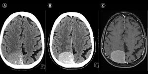 عکس مننژیوم مغزی _ دکتر علی احمدی