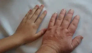 عکس آکرومالی _ انجمن جراحان قاعده جمجمه