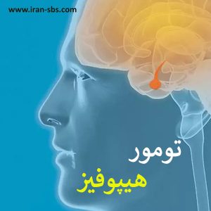 درمان تومور هیپوفیز در تهران _ انجمن جراحان قاعده جمجمه-iran-sbs.com