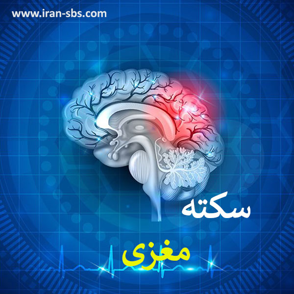 سکته مغزی _ انجمن جراحان قاعده جمجمه