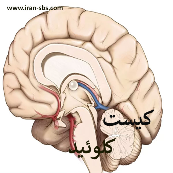 جراحی کیست کلوئید _ iran.sbs