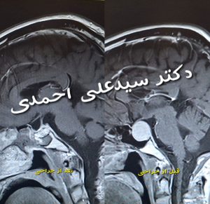 جراحی غده هیپوفیز در تهران _ دکتر سید علی احمدی