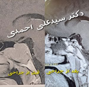 تصویر واقعی از جراحی هیپوفیز _ انجمن جراحان قاعده جمجمه