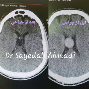 عمل قاعده جمجمه در تهران _ انجمن جراحان قاعده جمجمه