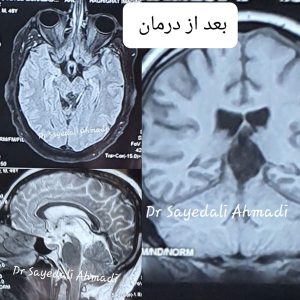عمل تومور قاعده جمجمه _ انجمن جراحان قاعده جمجمه