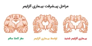 عکس پیشرفت بیماری آلزایمر - انجمن جراحان قاعده جمجمه