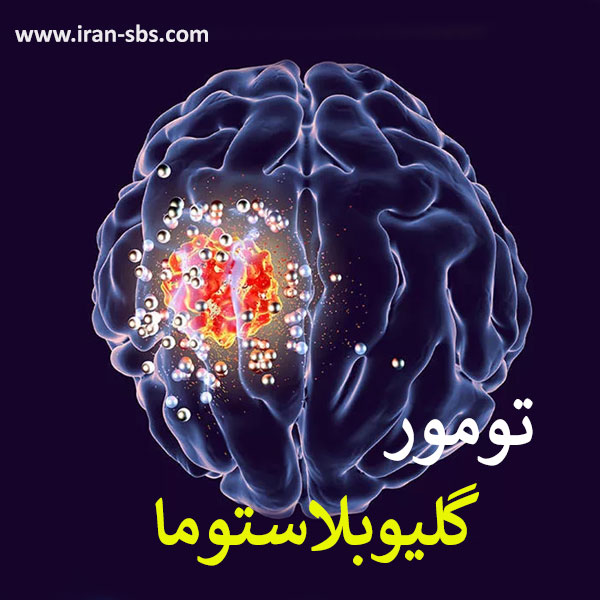 گلیوبلاستوما _ انجمن جراحان قاعده جمجمه