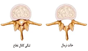 عکس تنگی کانال نخاعی _ iran sbs.ir