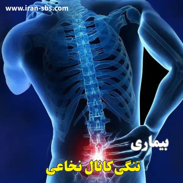 تنگی کانال نخاعی _ انجمن جراحان قاعده جمجمه