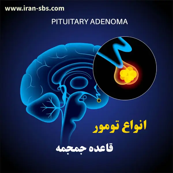 انواع تومور های قاعده جمجمه _ انجمن جراحان قاعده جمجمه