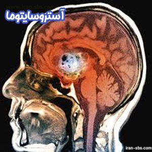 آستروسیتوما - جراحان قاعده جمجمه - iran-sbs.com