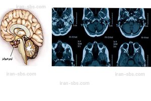 عکس تومور هیپوفیز - جراحان قاعده جمجمه - iran-sbs.com