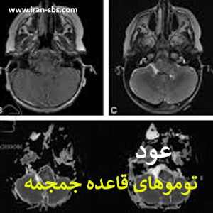عود تومورهای قاعده جمجمه - جراحاان قاعده جمجمه -iran-sbs.com