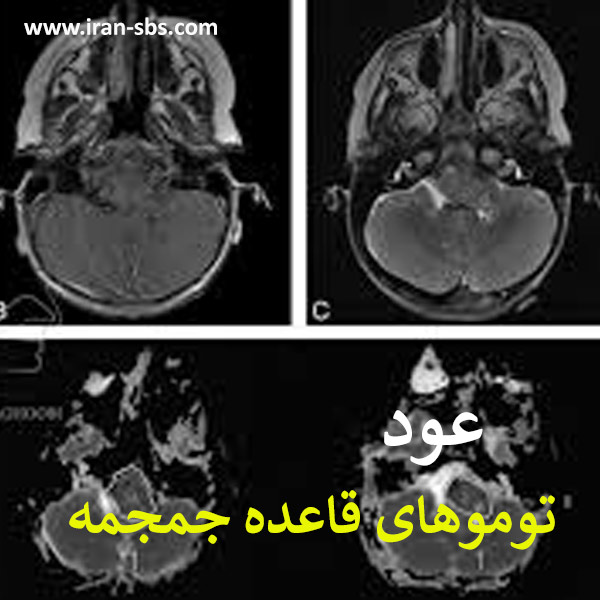 عود تومورهای قاعده جمجمه - جراحاان قاعده جمجمه -iran-sbs.com