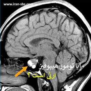 آیا تومور هیپوفیز ارثی است ؟ جراحان قاعده جمجمه - iran-sbs.com