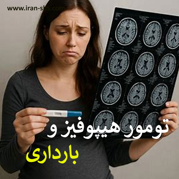 تومور هیپوفیز در دوره بارداری - جراحان قاعده جمجمه - iran-sbs.com