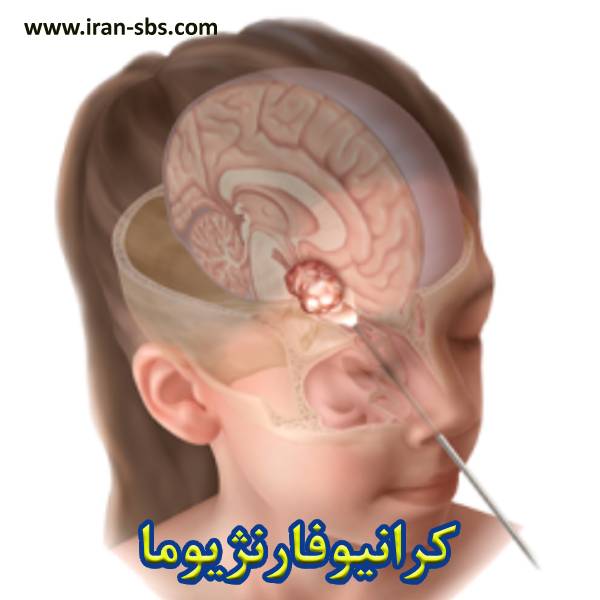 کرانیوفارنژیوما