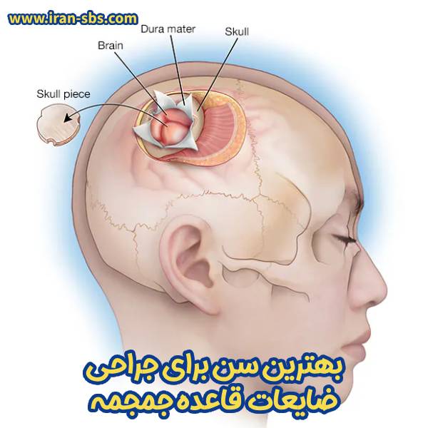 بهترین سن برای جراحی ضایعات قاعده جمجمه