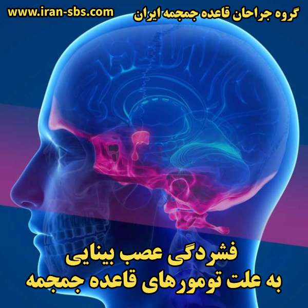 فشردگی عصب بینایی به علت تومورهای قاعده جمجمه