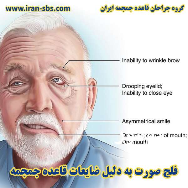 فلج صورت به دلیل ضایعات قاعده جمجمه