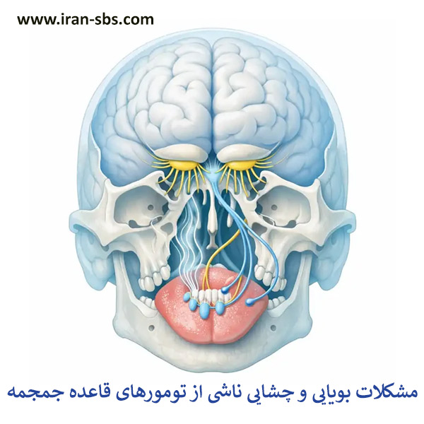 بررسی مشکلات بویایی و چشایی ناشی از تومورهای قاعده